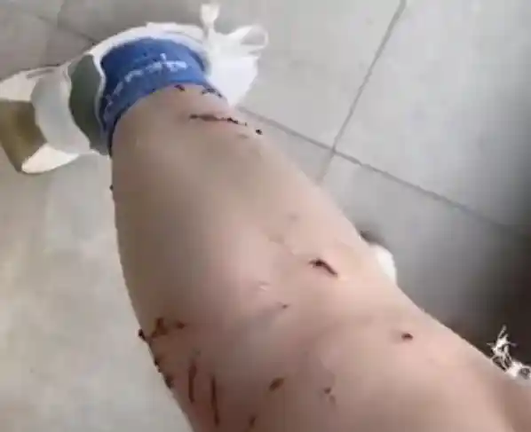 《女子被猫咬伤引发腿部溃烂，狂犬疫苗花费超1500元引热议》